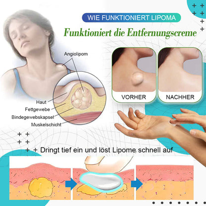 🟩LumpFree™ Lipom-Entfernungscreme